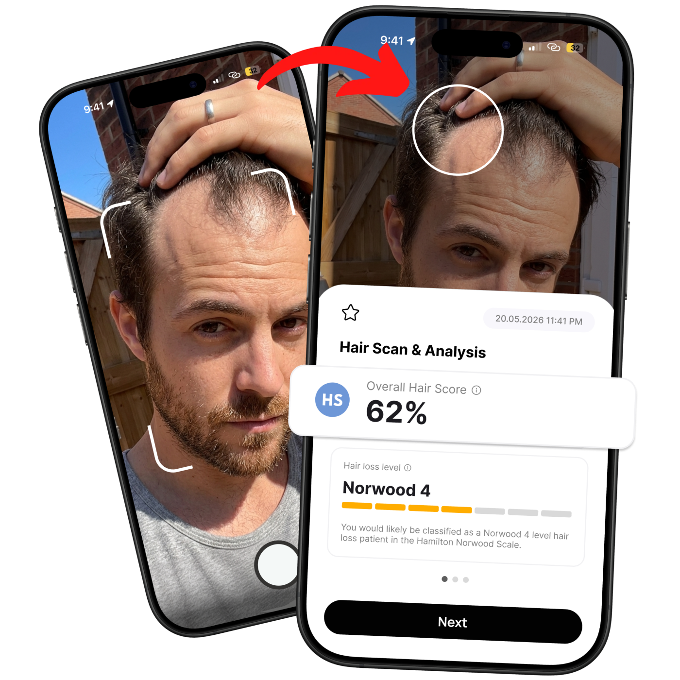 Hair loss assessment: before scan and after analysis with hair score